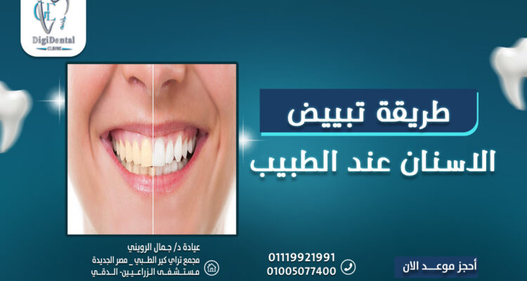 طريقة تبييض الاسنان عند الطبيب