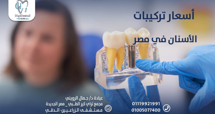 أسعار تركيبات الأسنان في مصر