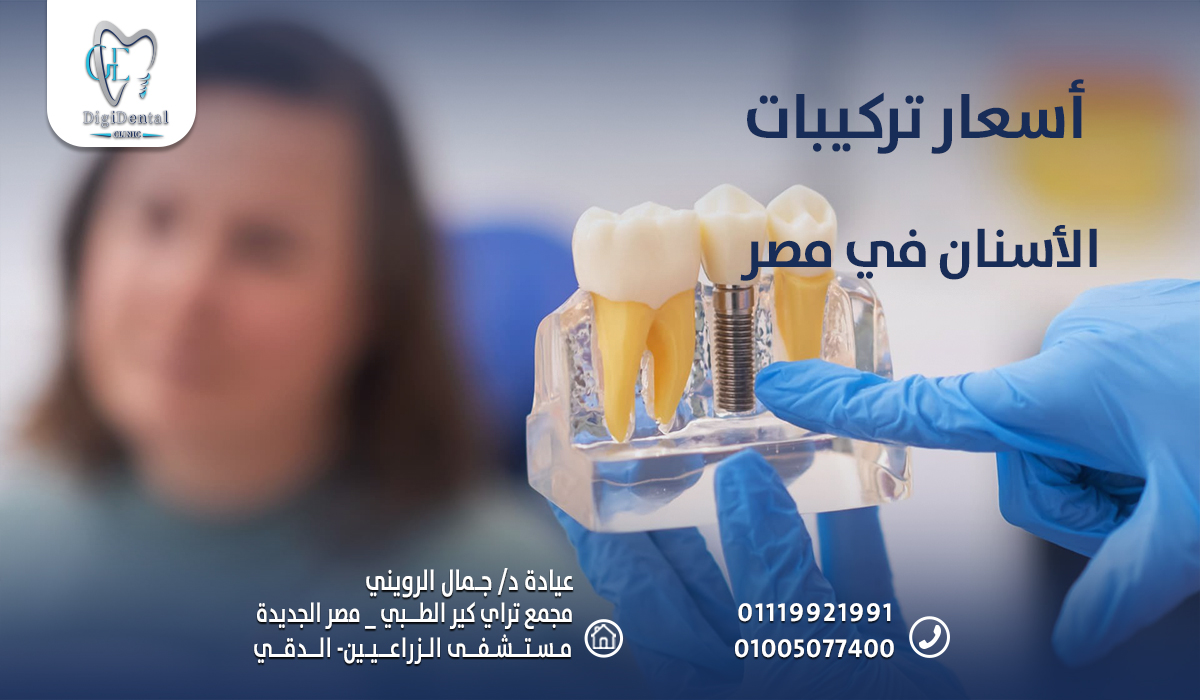 أسعار تركيبات الأسنان في مصر