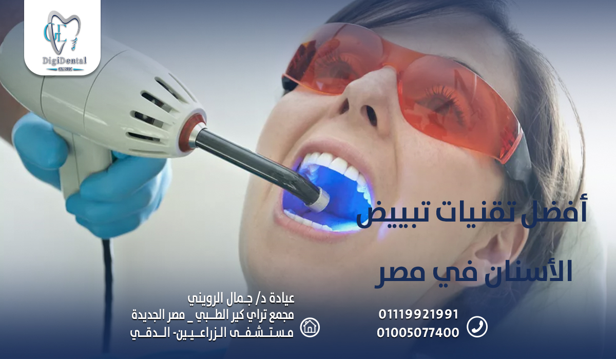 أفضل تقنيات تبييض الأسنان في مصر
