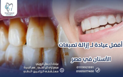 أفضل عيادة لـ إزالة تصبغات الأسنان في مصر
