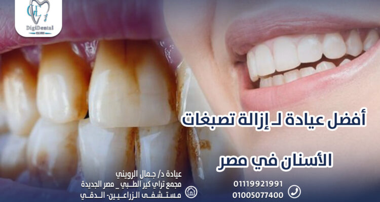 أفضل عيادة لـ إزالة تصبغات الأسنان في مصر