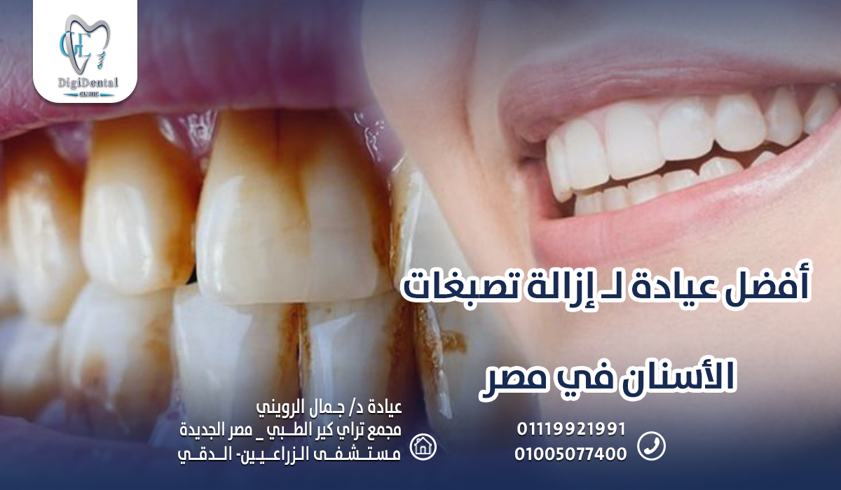 أفضل عيادة لـ إزالة تصبغات الأسنان في مصر