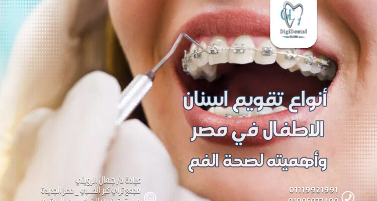 أنواع تقويم اسنان الاطفال في مصر وأهميته لصحة الفم