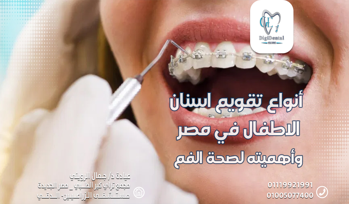 أنواع تقويم اسنان الاطفال في مصر وأهميته لصحة الفم