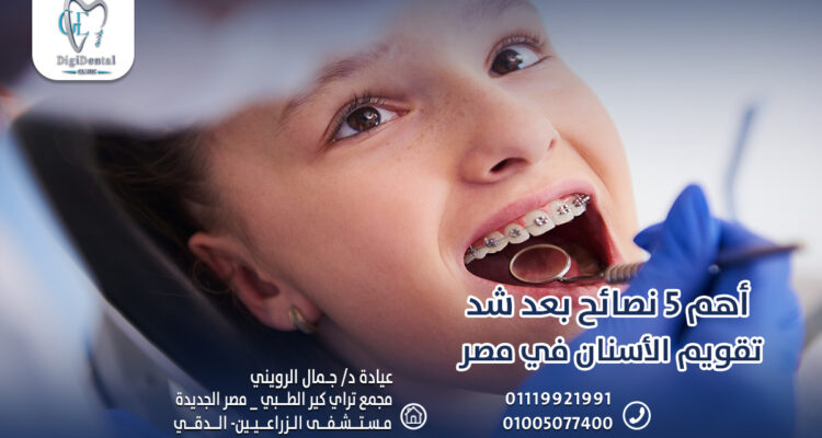 أهم 5 نصائح بعد شد تقويم الأسنان في مصر