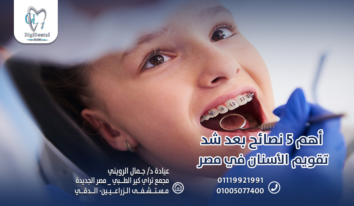 أهم 5 نصائح بعد شد تقويم الأسنان في مصر