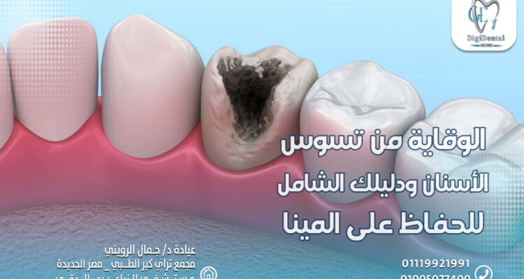 الوقاية من تسوس الأسنان ودليلك الشامل للحفاظ على المينا