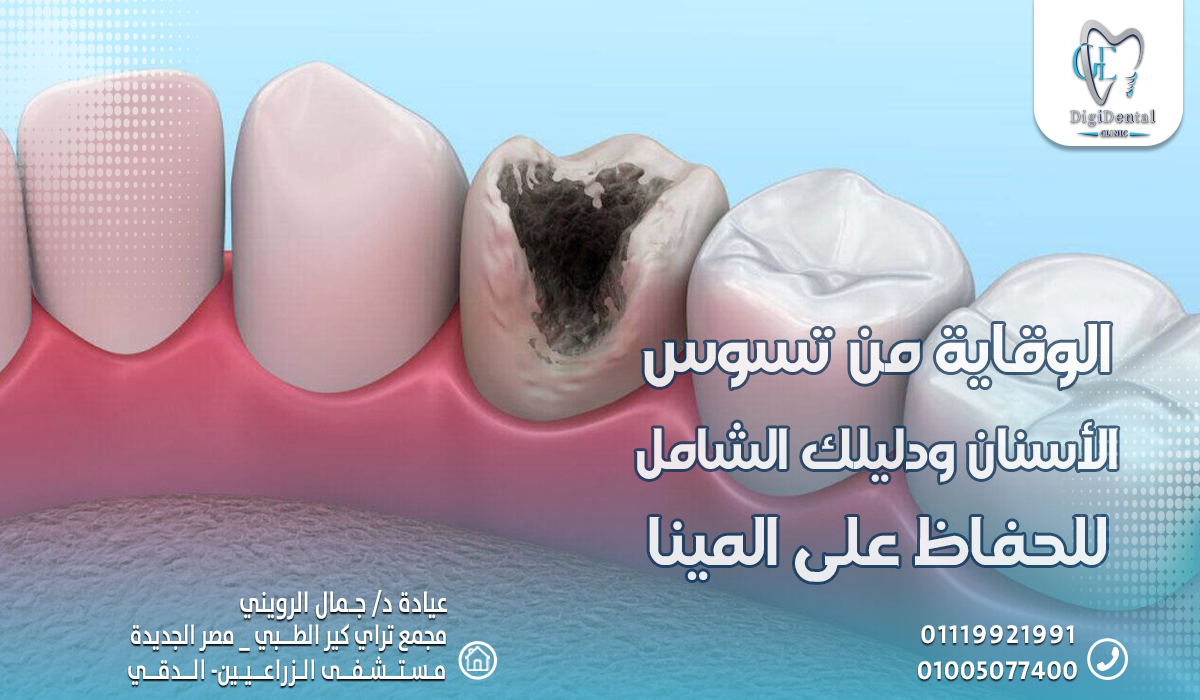 الوقاية من تسوس الأسنان ودليلك الشامل للحفاظ على المينا