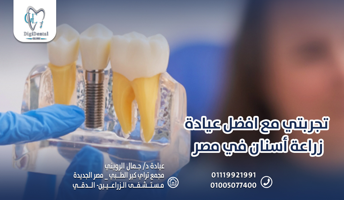 تجربتي مع افضل عيادة زراعة أسنان في مصر