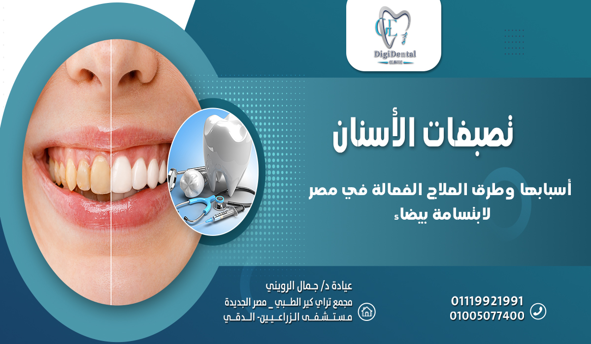 تصبغات الأسنان وأسبابها وطرق العلاج الفعالة في مصر لابتسامة بيضاء