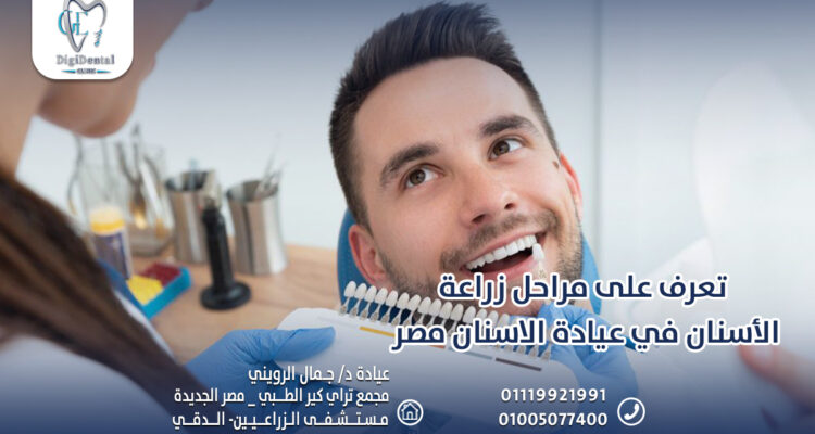 تعرف على مراحل زراعة الأسنان في عيادة الاسنان مصر