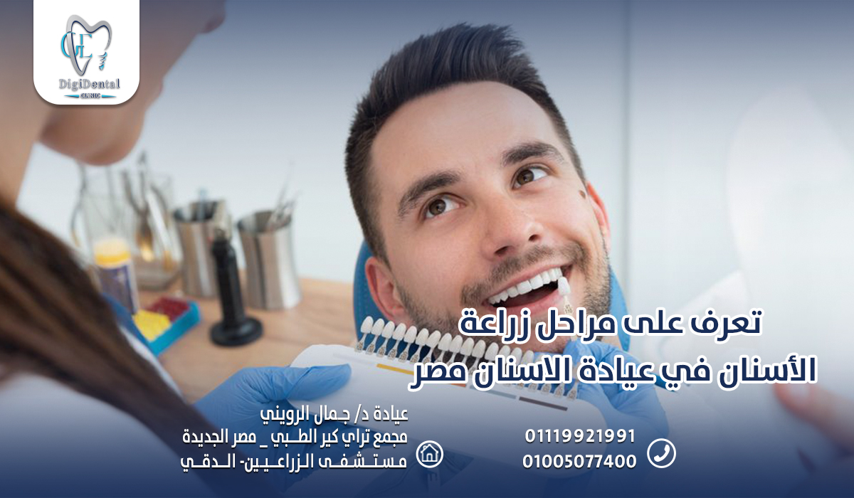 تعرف على مراحل زراعة الأسنان في عيادة الاسنان مصر