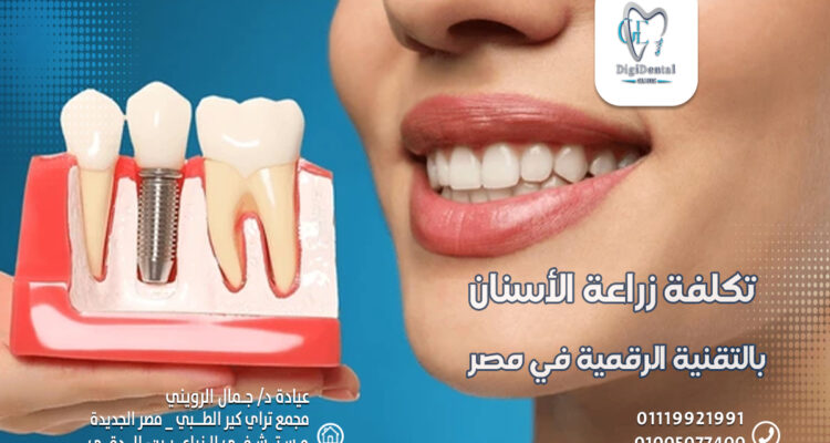 تكلفة زراعة الأسنان بالتقنية الرقمية في مصر