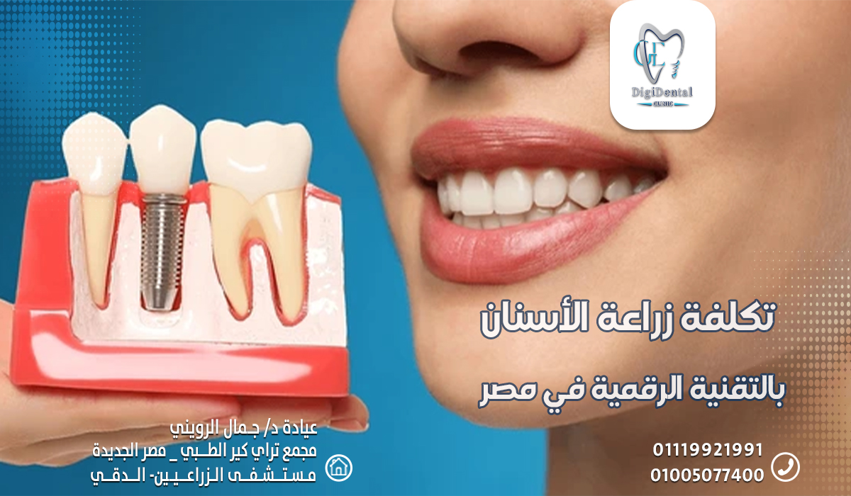 تكلفة زراعة الأسنان بالتقنية الرقمية في مصر