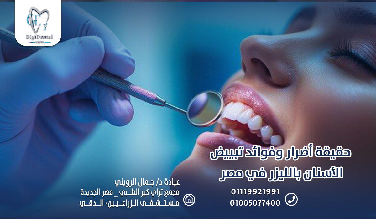 حقيقة أضرار وفوائد تبييض الأسنان بالليزر في مصر