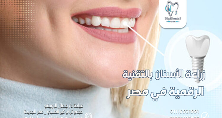 زراعة الأسنان بالتقنية الرقمية في مصر