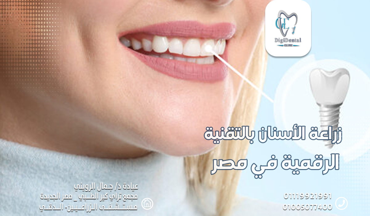 زراعة الأسنان بالتقنية الرقمية في مصر