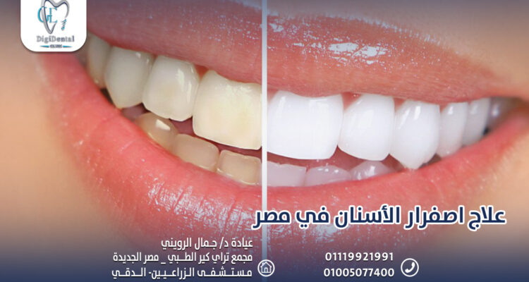 علاج اصفرار الأسنان في مصر