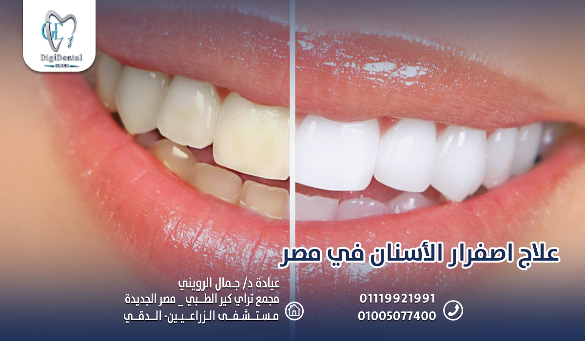 علاج اصفرار الأسنان في مصر