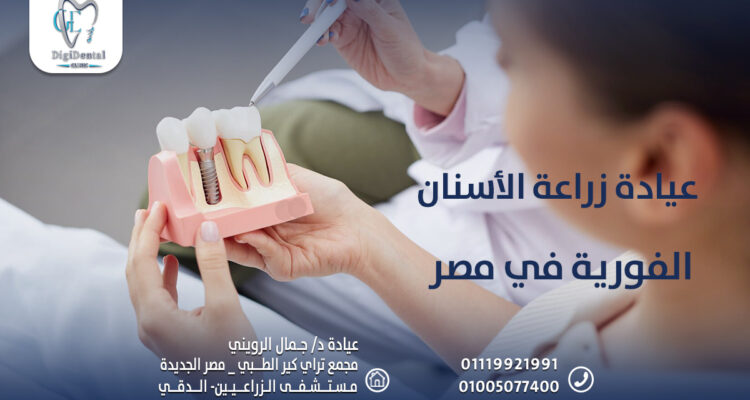 عيادة زراعة الأسنان الفورية في مصر