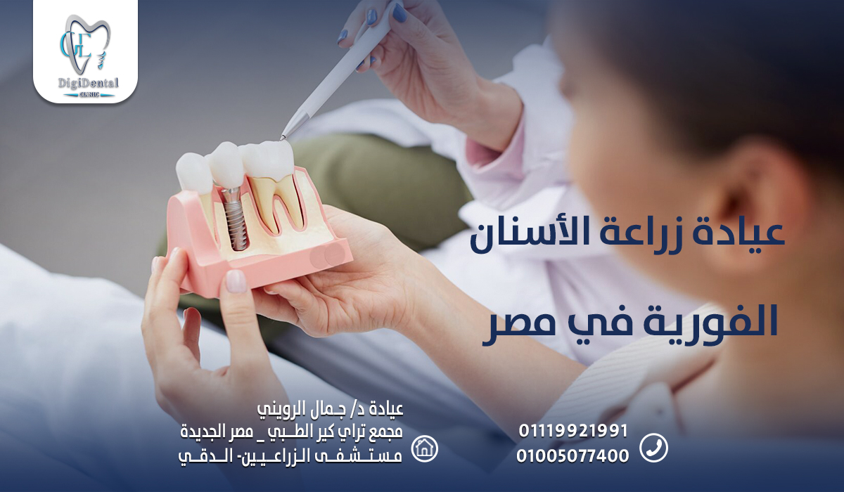 عيادة زراعة الأسنان الفورية في مصر