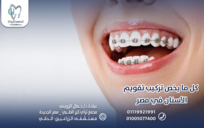 كل ما يخص تركيب تقويم الأسنان في مصر
