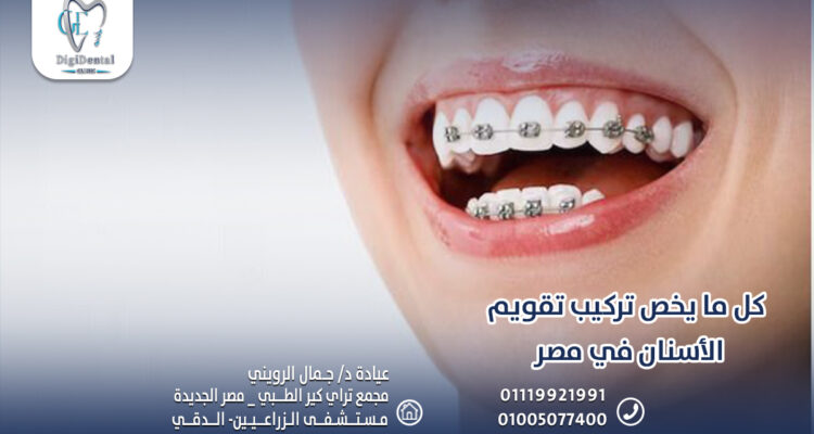 كل ما يخص تركيب تقويم الأسنان في مصر