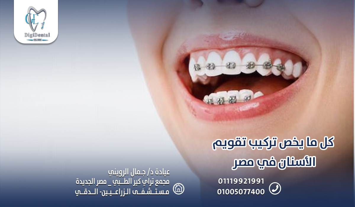 كل ما يخص تركيب تقويم الأسنان في مصر