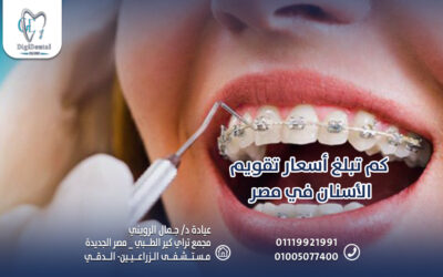 كم تبلغ أسعار تقويم الأسنان في مصر