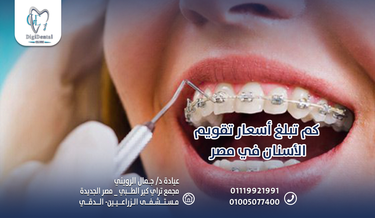 كم تبلغ أسعار تقويم الأسنان في مصر