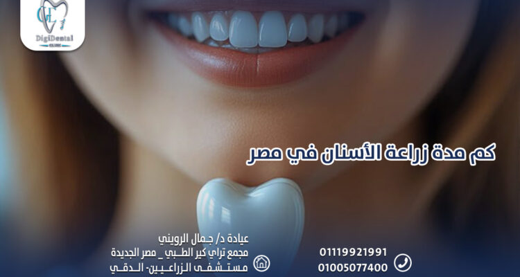 كم مدة زراعة الأسنان في مصر