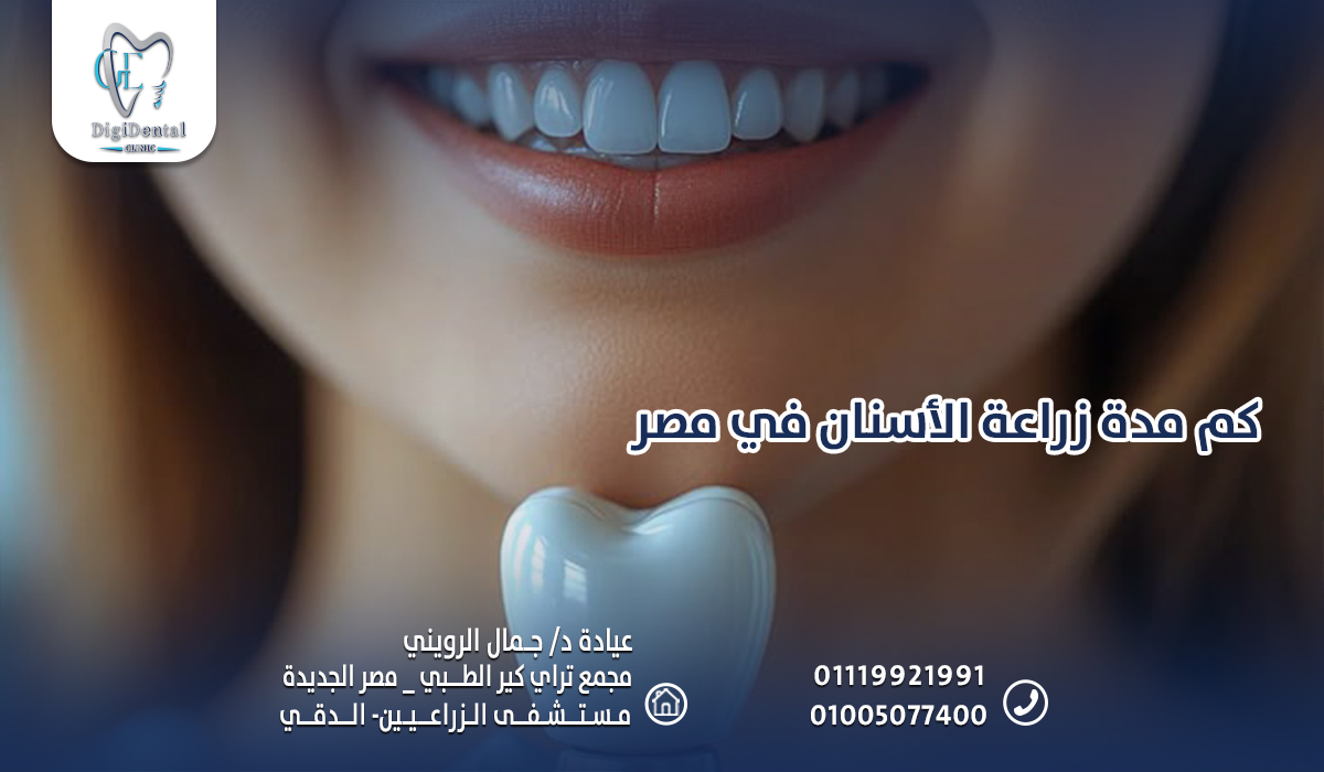 كم مدة زراعة الأسنان في مصر