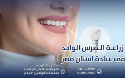 زراعة الضرس الواحد في عيادة اسنان مصر