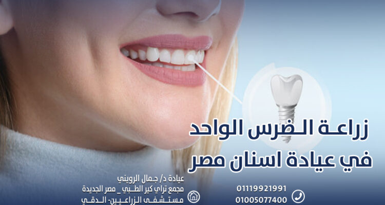زراعة الضرس الواحد في عيادة اسنان مصر