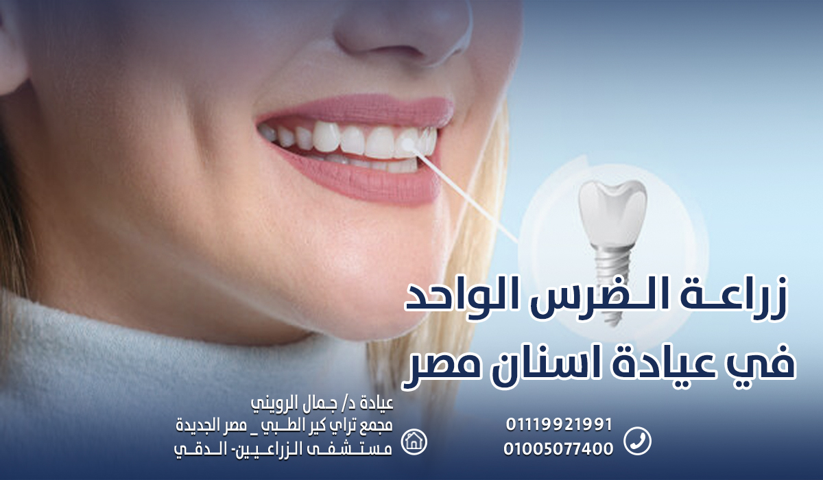 زراعة الضرس الواحد في عيادة اسنان مصر