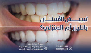 تبييض الأسنان بالليزر أم المنزلي؟