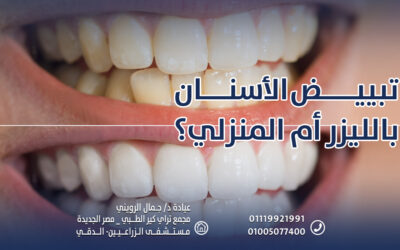 تبييض الأسنان بالليزر أم المنزلي؟
