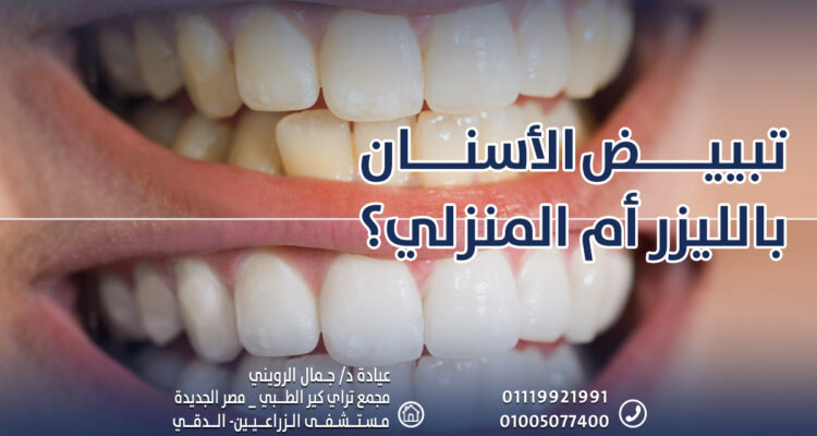 تبييض الأسنان بالليزر أم المنزلي؟