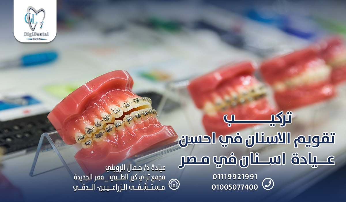 تركيب تقويم الاسنان في احسن عيادة اسنان في مصر