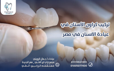 تركيب كراون الأسنان في عيادة الاسنان في مصر
