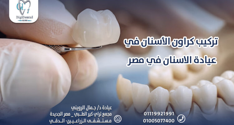 تركيب كراون الأسنان في عيادة الاسنان في مصر