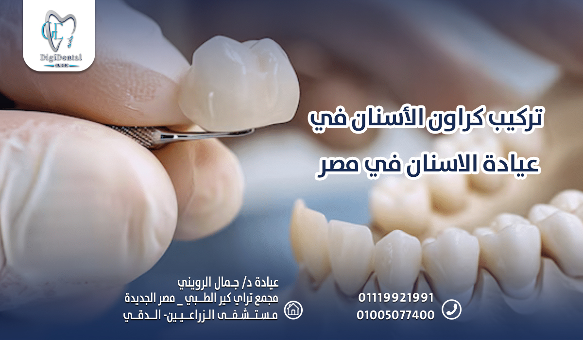 تركيب كراون الأسنان في عيادة الاسنان في مصر