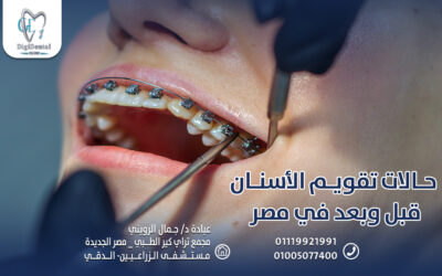 حالات تقويم الأسنان قبل وبعد في مصر