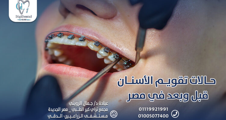 حالات تقويم الأسنان قبل وبعد في مصر