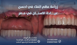 قم بـ زراعة عظم الفك في احسن عيادة الاسنان في مصر