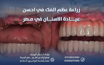 قم بـ زراعة عظم الفك في احسن عيادة الاسنان في مصر