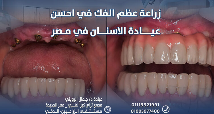 قم بـ زراعة عظم الفك في احسن عيادة الاسنان في مصر