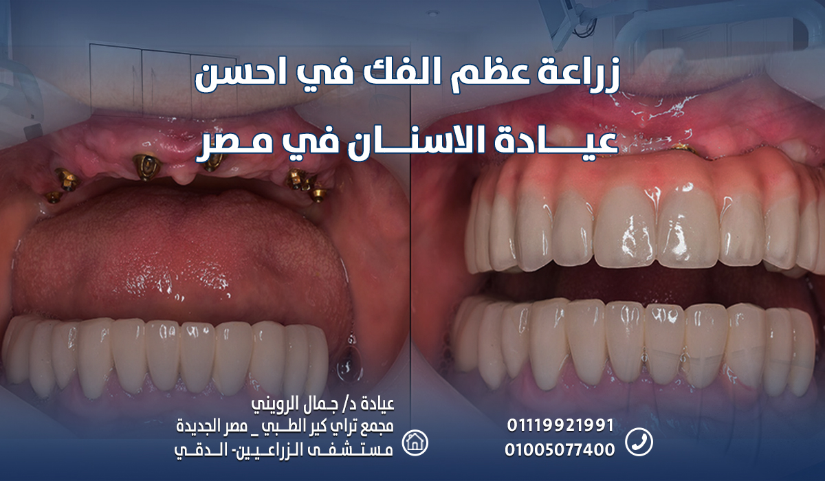 قم بـ زراعة عظم الفك في احسن عيادة الاسنان في مصر