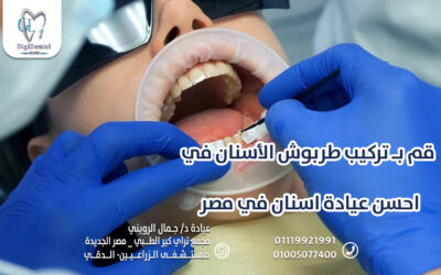 قم بـ تركيب طربوش الأسنان في احسن عيادة اسنان في مصر